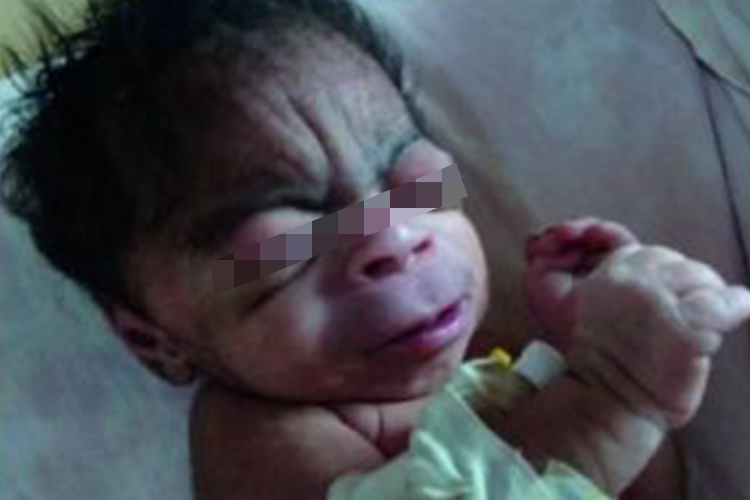 德朗热综合征面部特征图