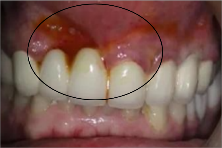 急性浆液性根尖周炎渗液图