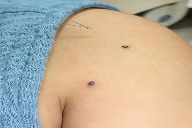 蜱虫咬人后症状图