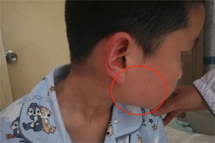 急性化脓性腮腺炎图