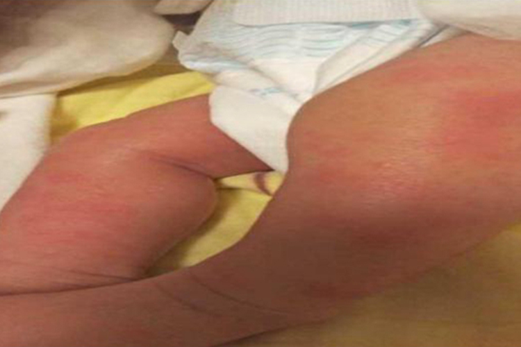 湿疹宝宝腿上一片一片红图