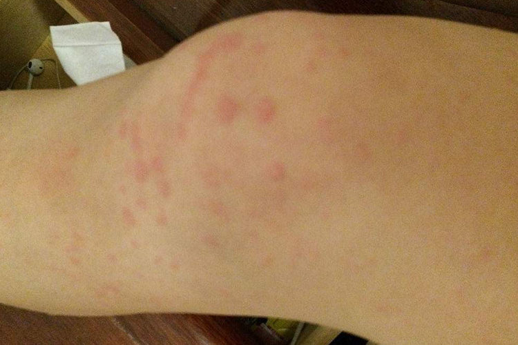 膝盖划痕性荨麻疹图