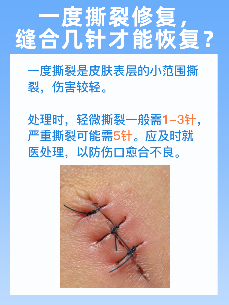 一度撕裂修复,缝合几针才能恢复?