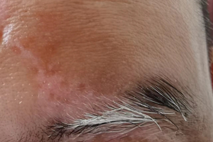 白癜风面部毛发变白图 白癜风面部毛发变白图