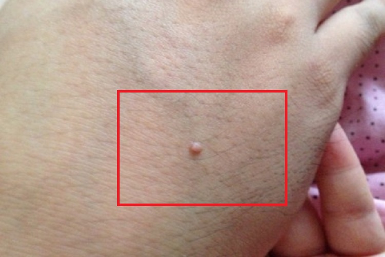 单发性有蒂软纤维瘤手背症状图 单发性有蒂软纤维瘤手背症状图