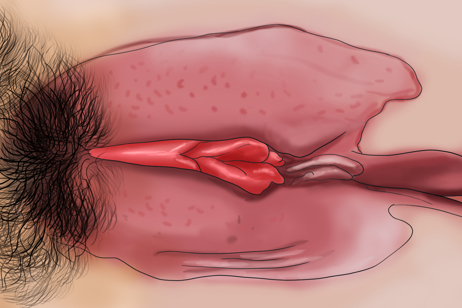 急性外阴炎大阴唇红肿手绘图