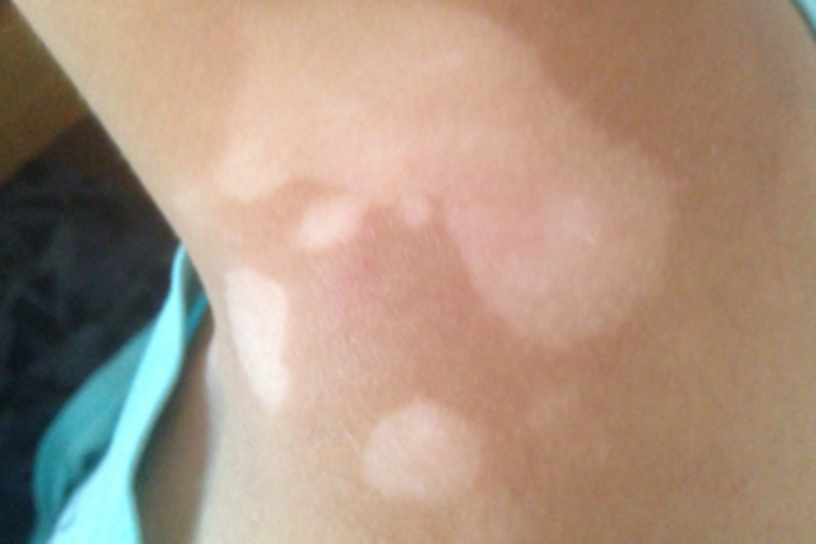 花斑糠疹肩膀有白斑图