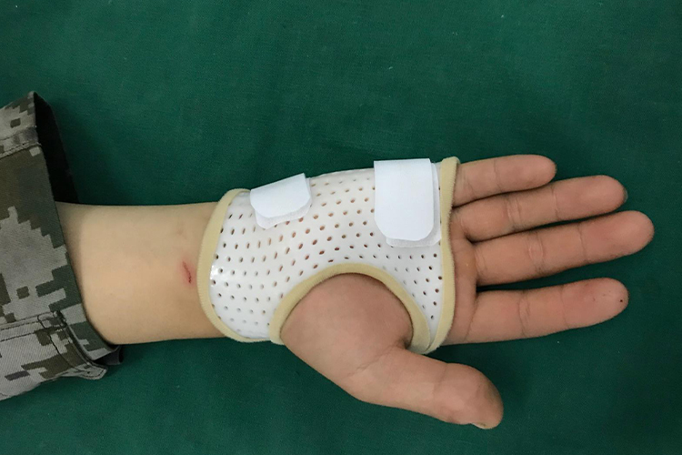 手掌轻微骨裂固定图