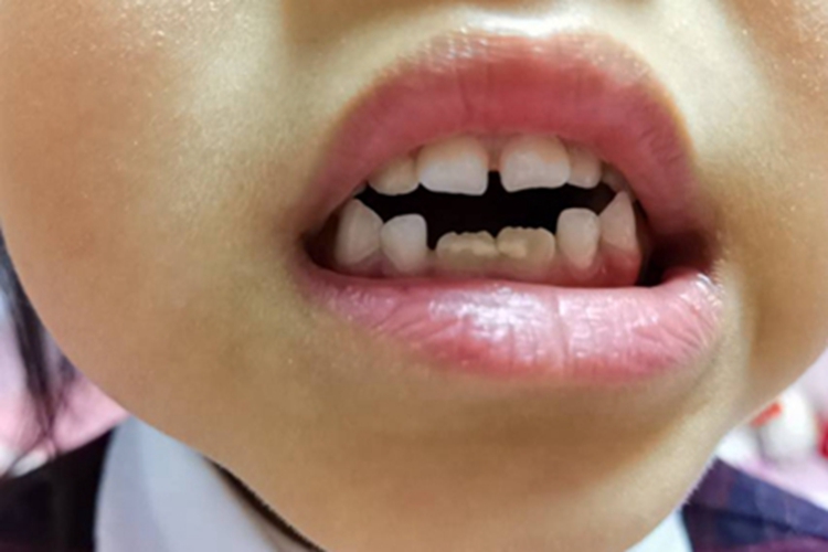 氟斑牙牙齿发黄凹凸不平图