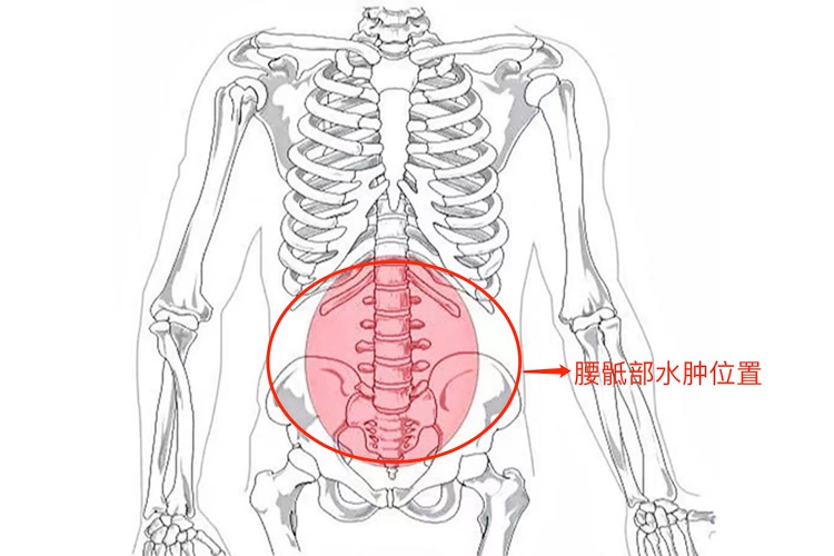 腰骶部水肿位置图