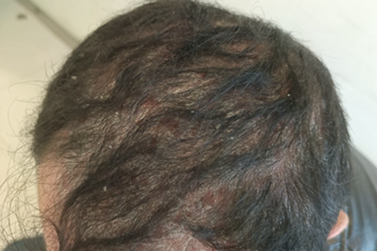 寻常型银屑病头皮大量鳞屑图