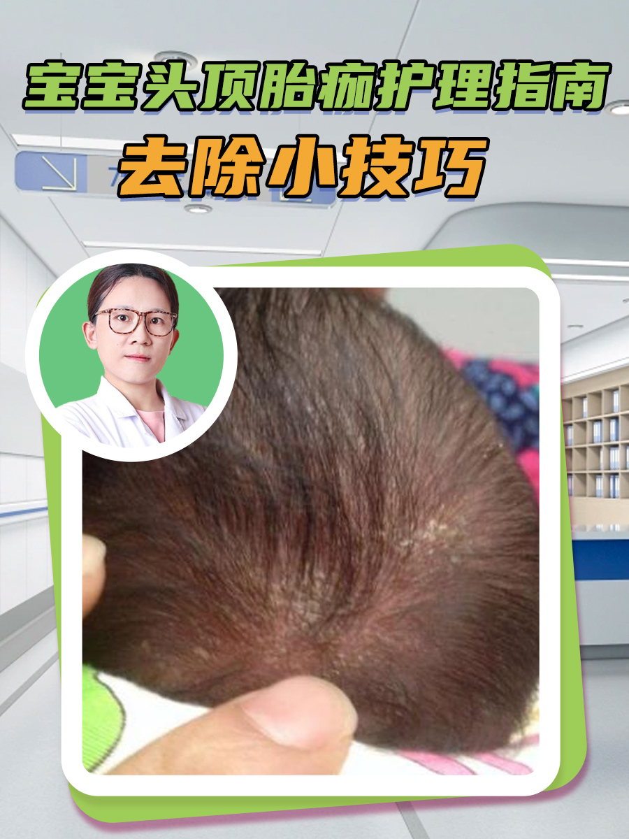 宝宝头顶胎痂护理指南:去除小技巧