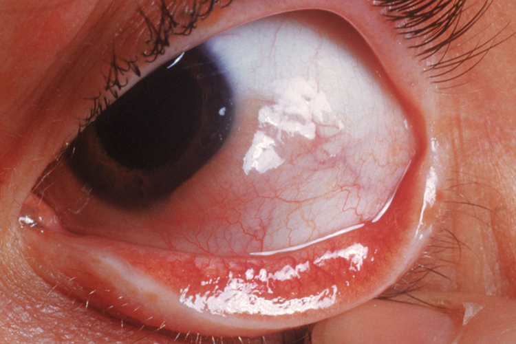 眼睛发红伴结膜水肿图