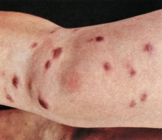 结节病皮下结节图