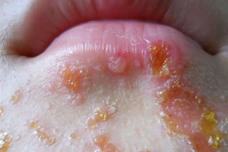 角层下脓疱性皮病下巴黄痂图