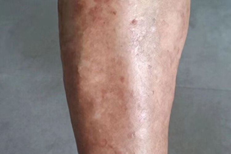 急性湿疹小腿发红长红斑图 急性湿疹小腿发红长红斑图