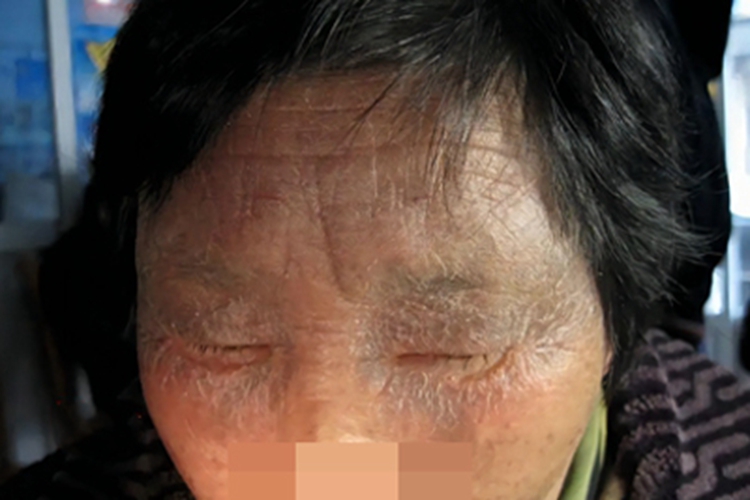 炎症后色素沉着皮肤颜色加深图