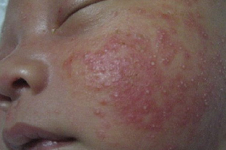婴儿湿疹丘疹图
