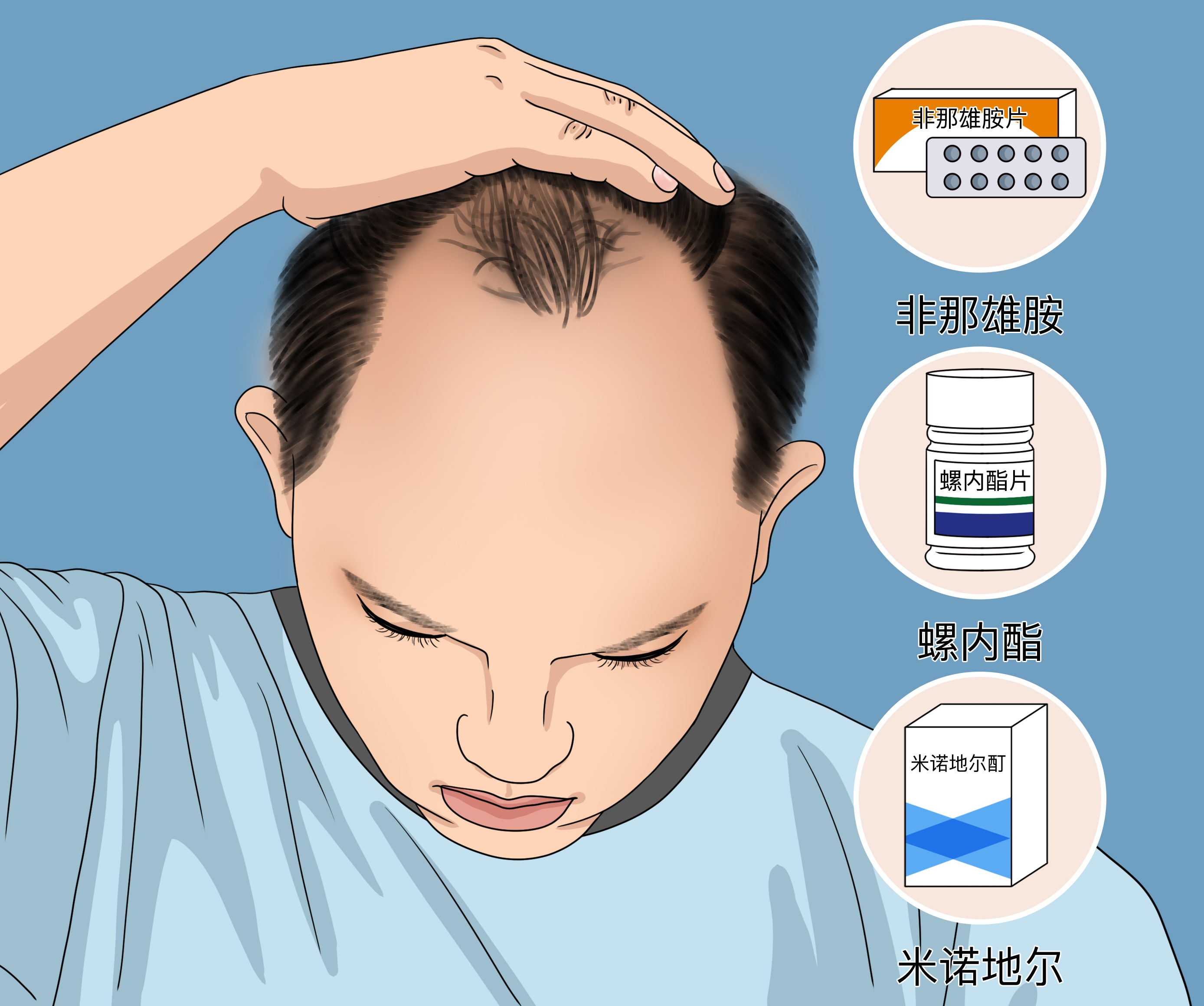 #脱发脂溢性脱发的成因是什么？ 👦👨脂溢性脱发是脱_圈子-新氧美容整形