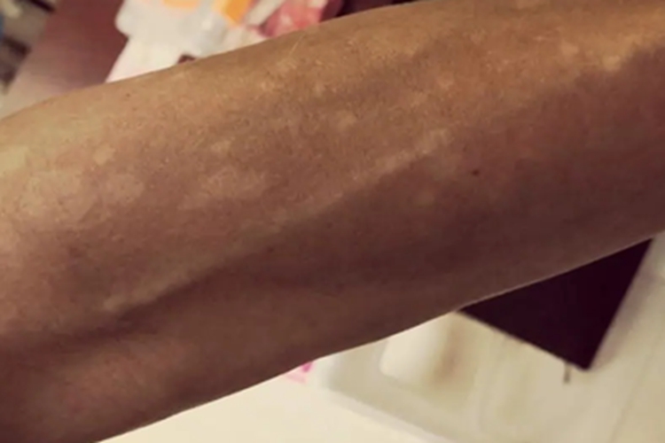 花斑糠疹胳膊上有圆形白斑图