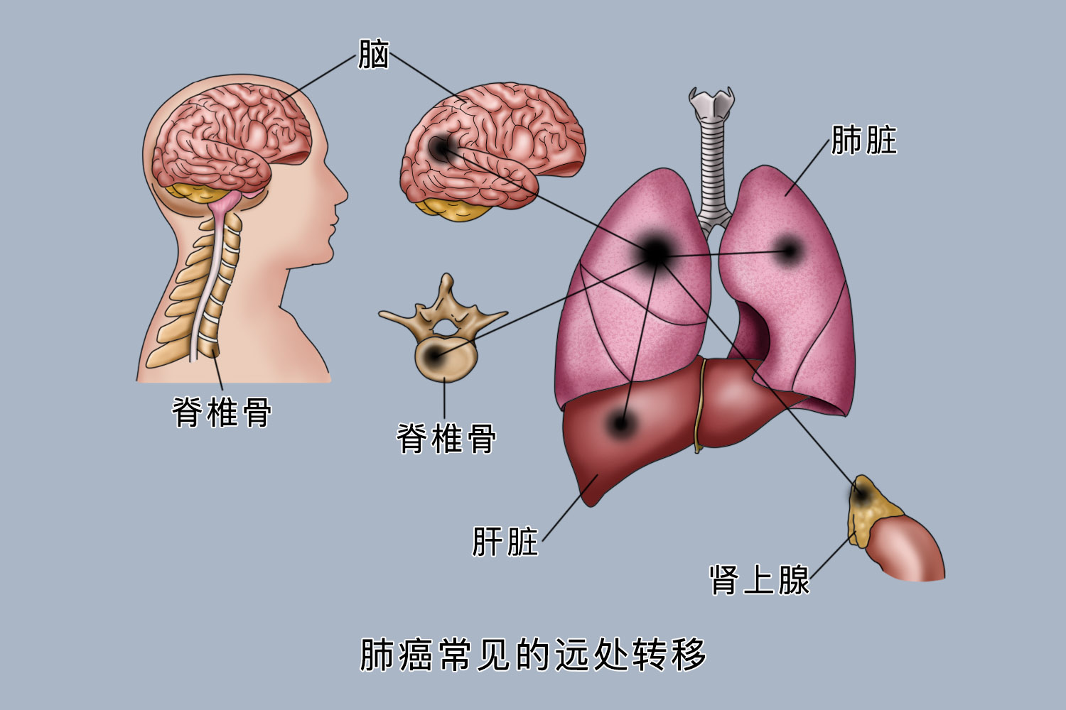 肺癌血行转移图