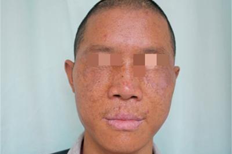 移植物抗宿主病面部症状图