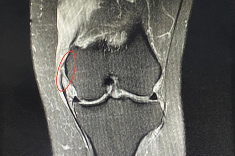 内侧副韧带损伤图