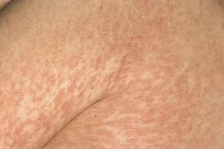 麻疹恢复期图 麻疹恢复期图