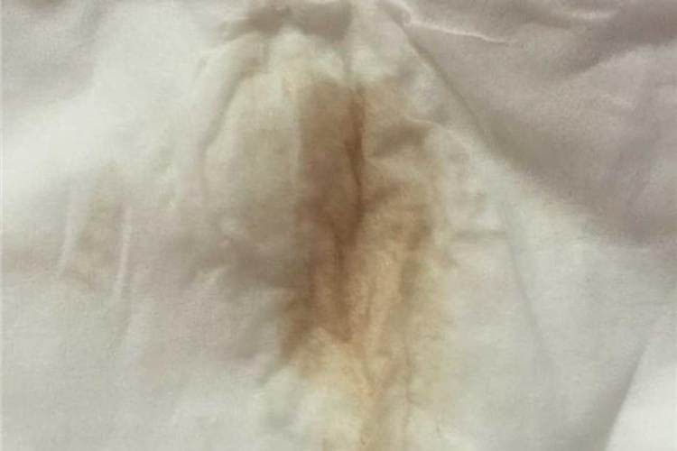 宫颈炎塞药排出黄色白带图