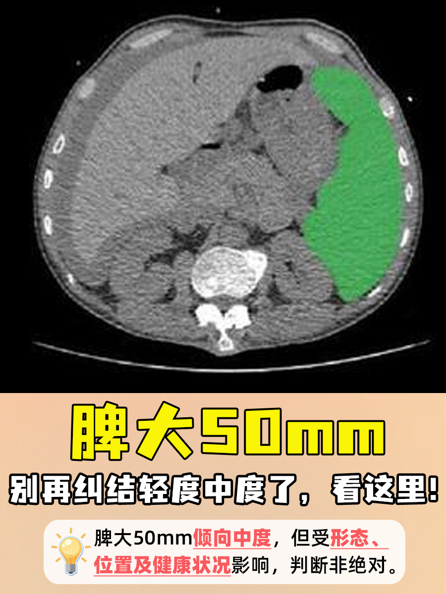 脾大50mm，别再纠结轻度中度了，看这里！