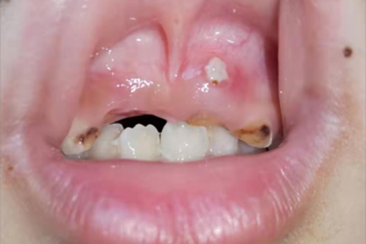 急性化脓性根尖周炎症状图