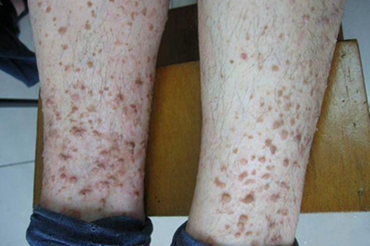 疣状肢端角化病小腿疙瘩图