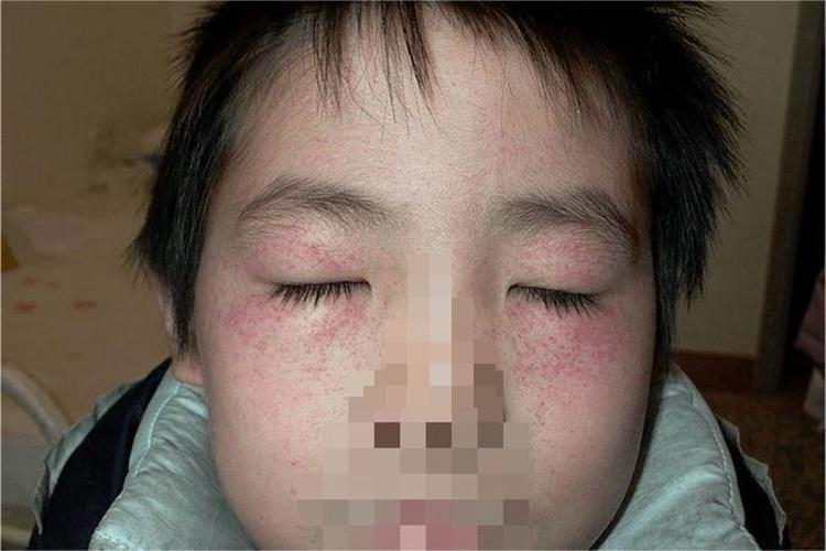 血管内压力增多性紫癜眼睑症状图 血管内压力增多性紫癜眼睑症状图