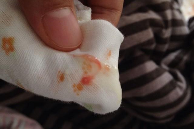 新生儿吐奶鲜红血丝图