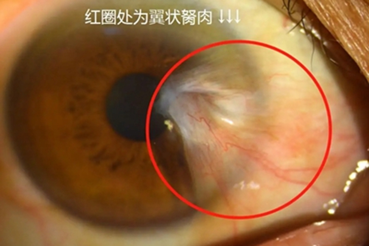 静止期翼状胬肉症状图