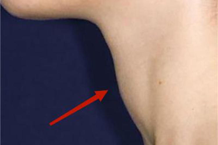 单纯性甲状腺肿前颈肿大图 单纯性甲状腺肿前颈肿大图