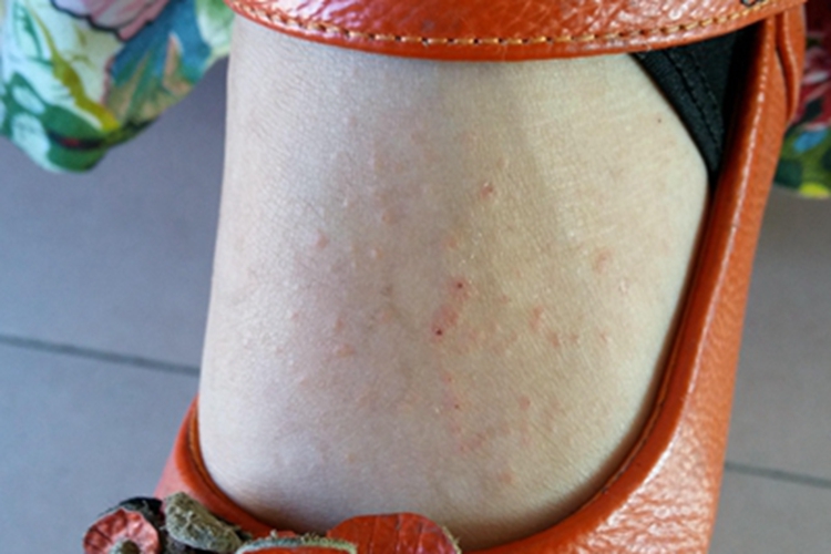 战壕热症状图 战壕热症状图