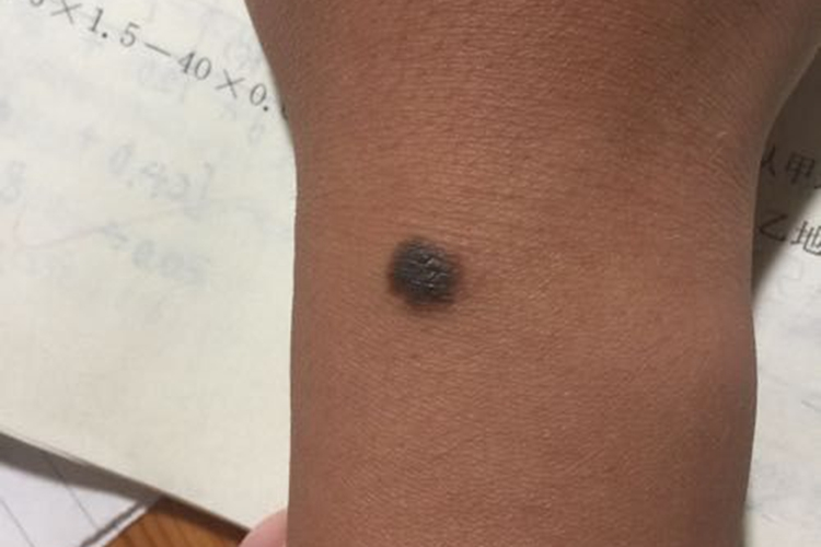 手上有色素痣图 手上有色素痣图