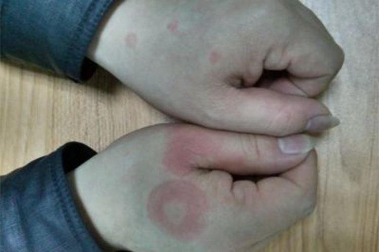 匐行性回状红斑手背症状图