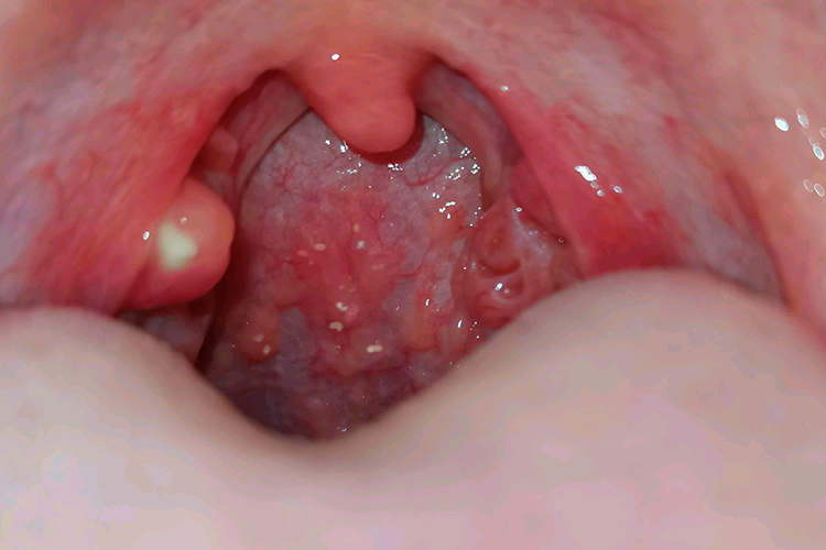 急性咽炎小舌头发炎图