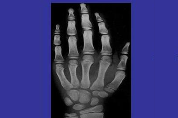 九岁男孩骨龄图