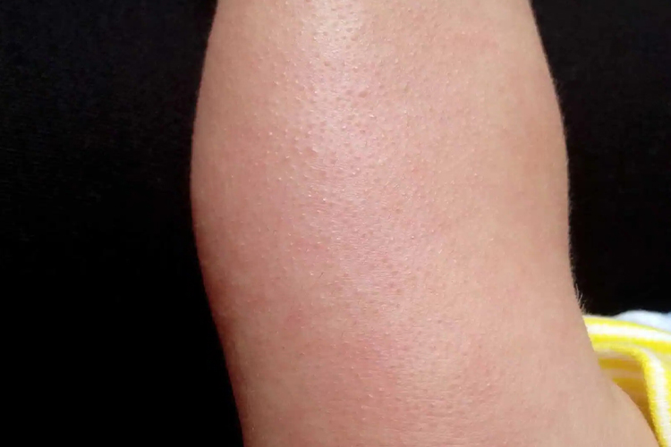 婴儿皮肤粗糙颗粒状图