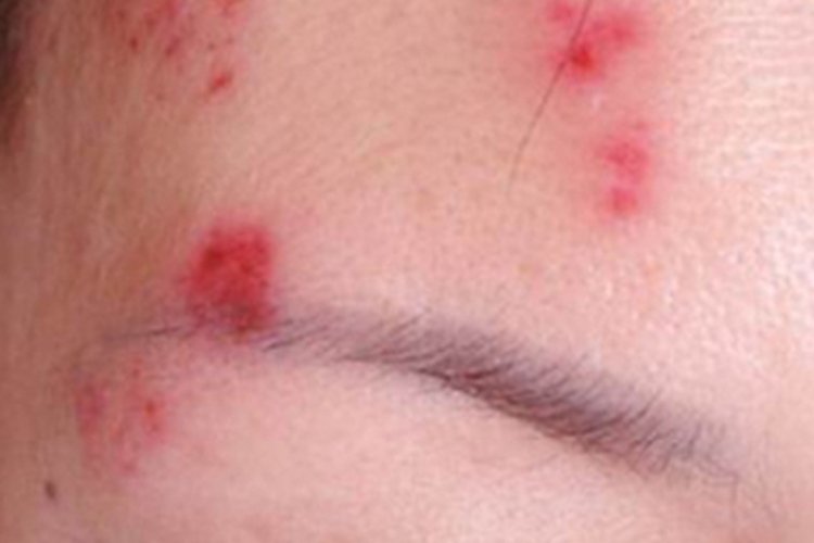 水痘眉毛上长了很多红点图