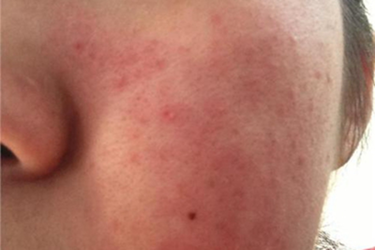 接触性睑皮炎面部丘疹图 接触性睑皮炎面部丘疹图