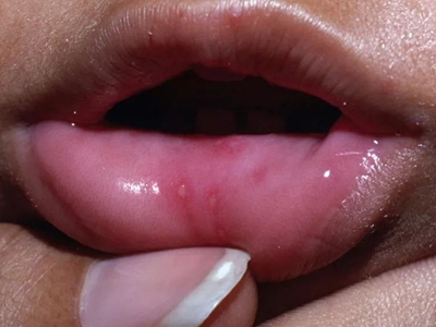 嘴唇疱疹的症状图片图片