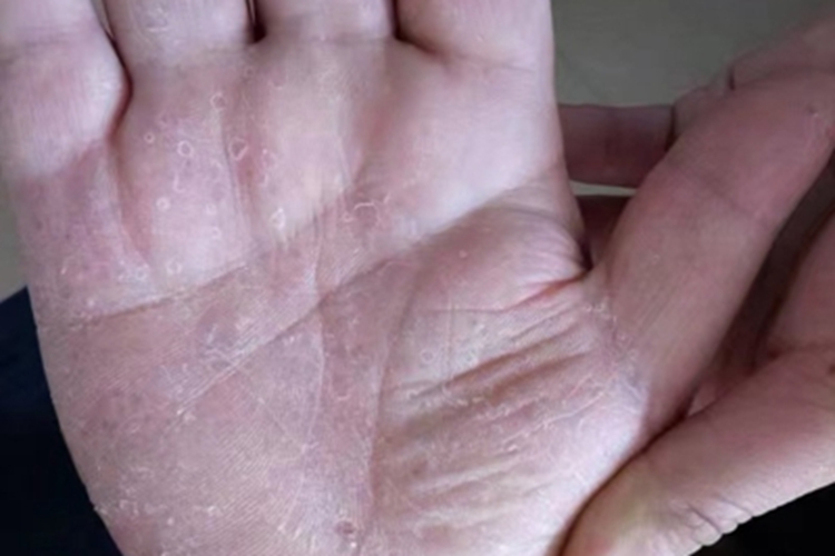 水疱型手癣脱皮图