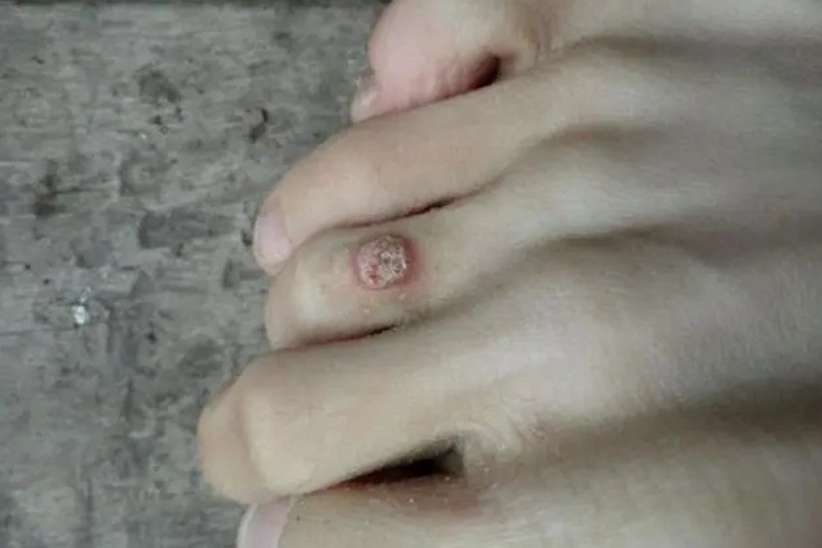 疣脚趾结节图