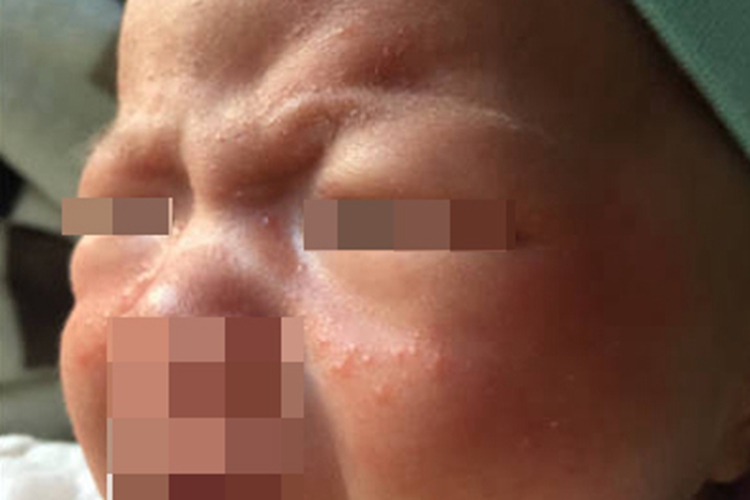 婴儿期特应性皮炎脸上有丘疹图 婴儿期特应性皮炎脸上有丘疹图