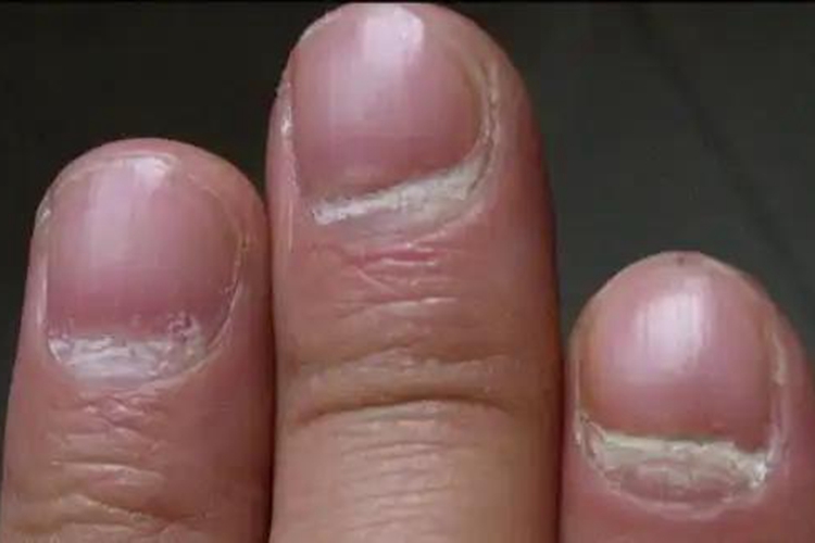 指甲横着凹进去一道沟图