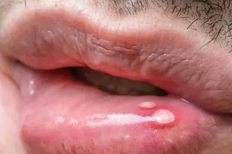 二期口腔梅毒下嘴唇里有白斑图 二期口腔梅毒下嘴唇里有白斑图